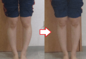 横浜市O脚矯正、ビフォーアフター